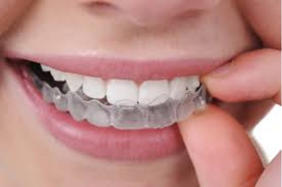 Tẩy trắng răng tại nhà