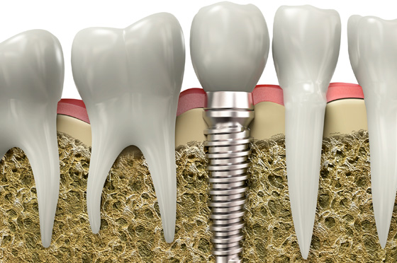 Implant là gì? Lợi ích của Implant.