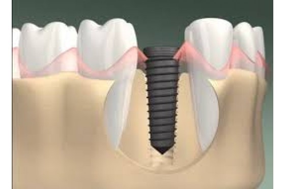 Implant kết hợp làm răng sứ ngay