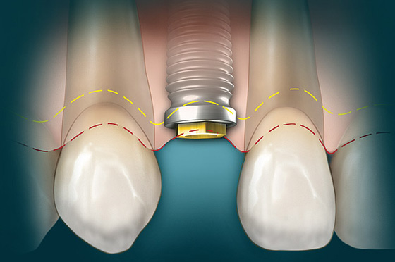 Một số câu hỏi thường gặp về Implant