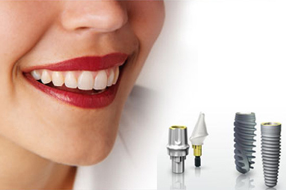 Quy trình cấy ghép Implant