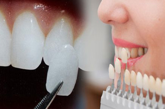 Quy trình làm Veneers