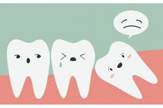Răng khôn mọc lệch có nên nhổ không?